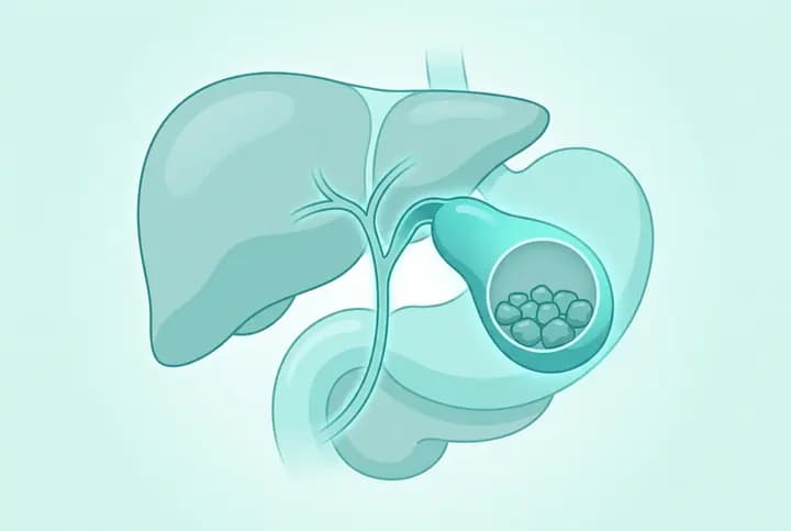 Gallbladder Stones
