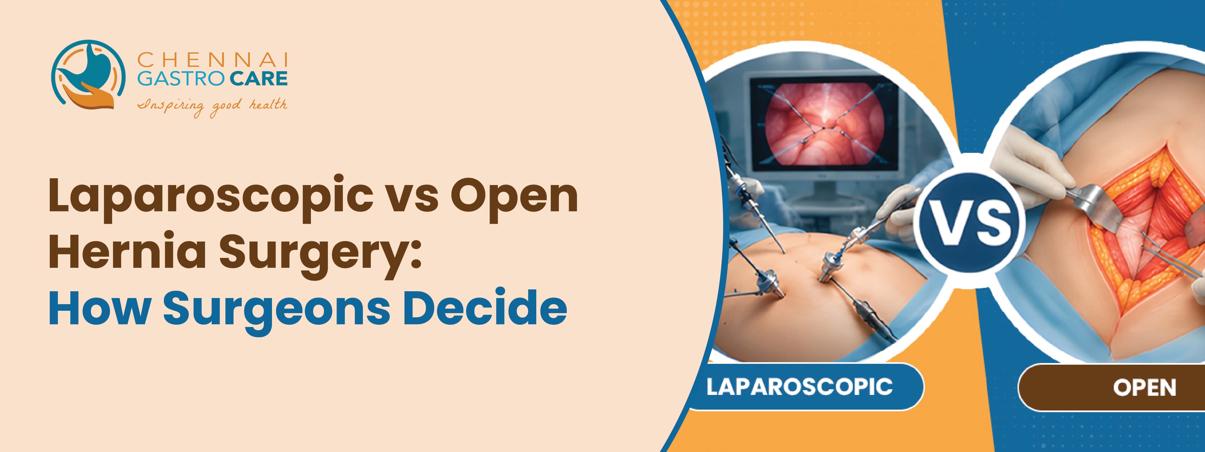 Laparoscopic vs Open Hernia Surgery: How Surgeons Decide