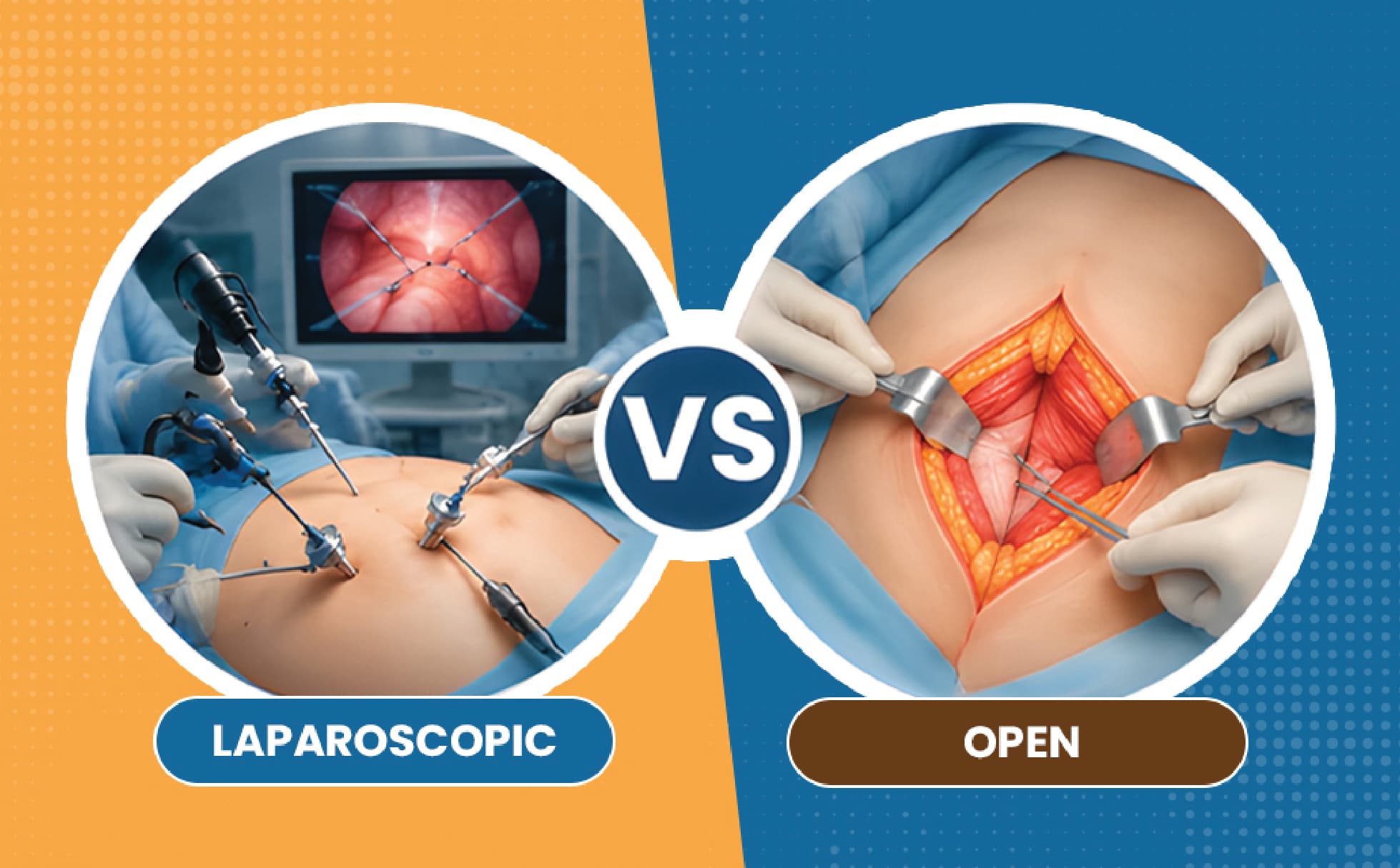 Laparoscopic vs Open Hernia Surgery: How Surgeons Decide