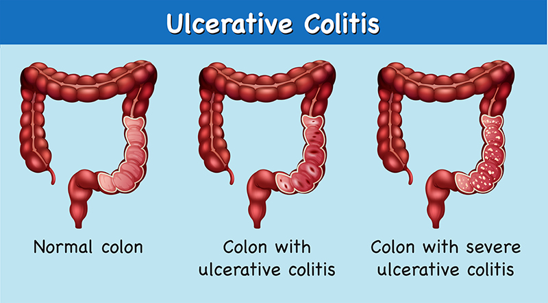 Fundamentals Of Ulcerative Colitis: Symptoms & Treatments